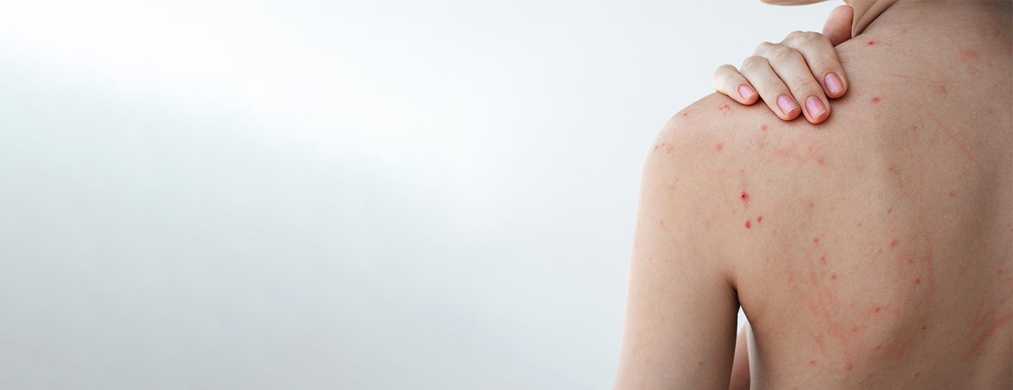 Coșuri pe spate: Ce funcționează cu adevărat împotriva bacne-ului, potrivit dermatologului