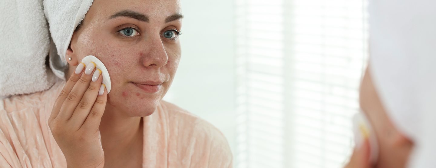 Acneea tardivă: ce ajută în cazul acneei la adulți