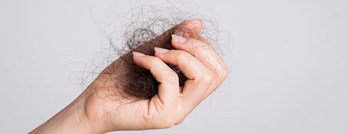Căderea circulară a părului: care sunt cauzele și poate fi vindecată?