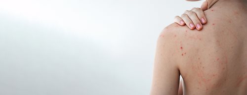 Coșuri pe spate: Ce funcționează cu adevărat împotriva bacne-ului, potrivit dermatologului