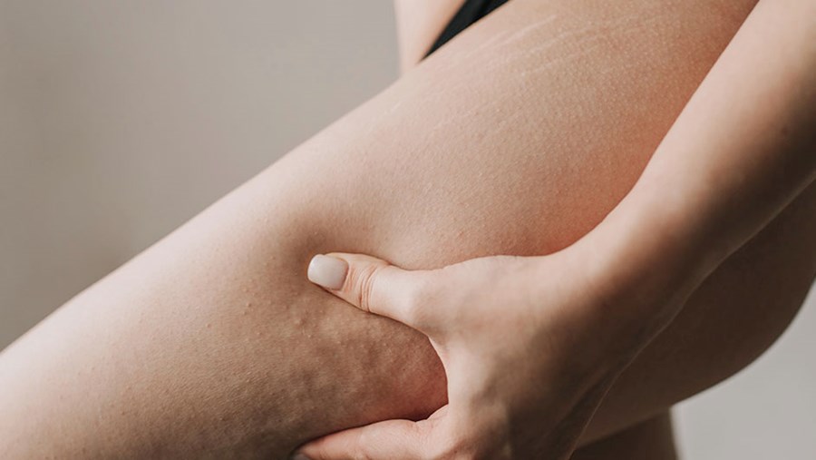 Frau, die sich fragt, ob man ihre Cellulite behandeln kann.